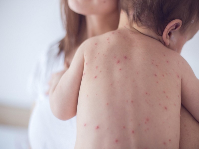 Ações contra surto buscam garantir recertificação de país livre do sarampo