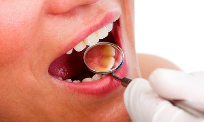 Prevenção é a melhor medida contra o câncer bucal
