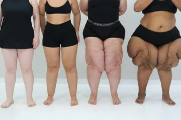 Lipedema: quando não é “apenas gordura localizada”