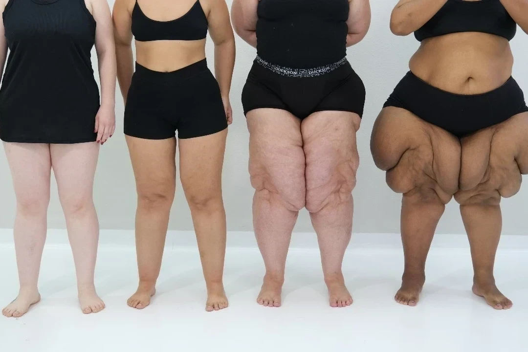 Lipedema: quando não é “apenas gordura localizada”